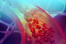 Standard Fasting Blood Lipid Profile